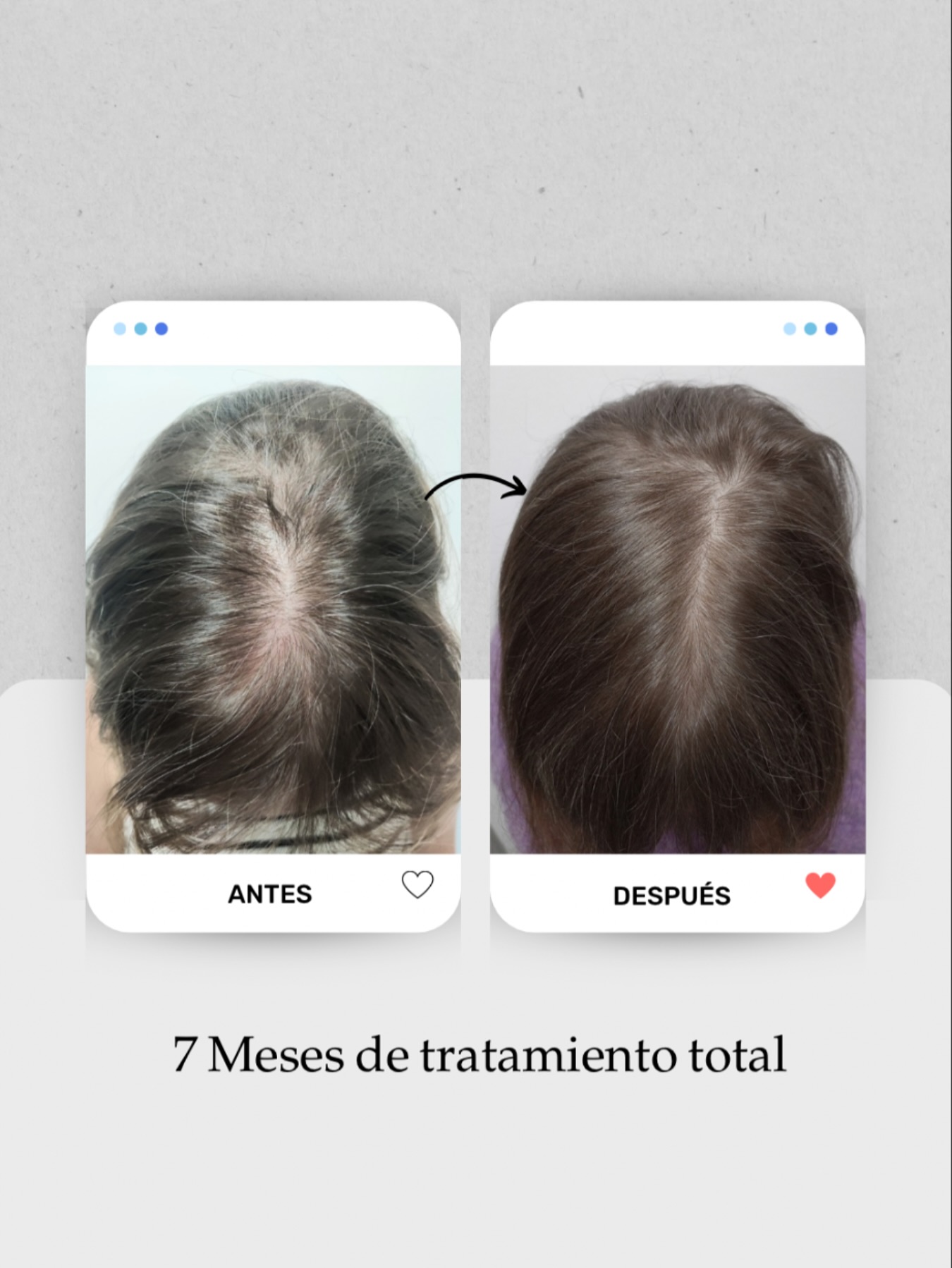 ✨Cuando esta paciente llegó a nuestra consulta, presentaba una alopecia androgenética femenina en grado II, lo que afectaba su autoestima y sus opciones de peinado.
✔️Tras un tratamiento médico de 7 meses, que incluyó suplementos, medicamentos orales, 3 sesiones de bioestimulación capilar y 3 sesiones de mesoterapia, los resultados son evidentes.
💪🏼Su cabello ha recuperado densidad y grosor, permitiéndole lucir peinados y color que antes evitaba. Con un plan de mantenimiento adecuado, podrá seguir disfrutando de su renovada confianza.
Si quieres saber cómo podemos ayudarte a mejorar tu cabello, agenda tu cita en Lanzarote o Las Palmas de Gran Canaria. ¡Estoy aquí para ti! ⬇️
📱 +34 680 73 14 53 📍Lanzarote
📱 +34 696 38 27 55 📍Las Palmas de Gran Canaria
#alopecia #alopeciafemenina #medicinacapilarcanarias #tricologiacapilar #vitaminascapilares #medicinaesteticacapilar #plasmacapilar #calvicie #calviciefemenina #injertocapilar