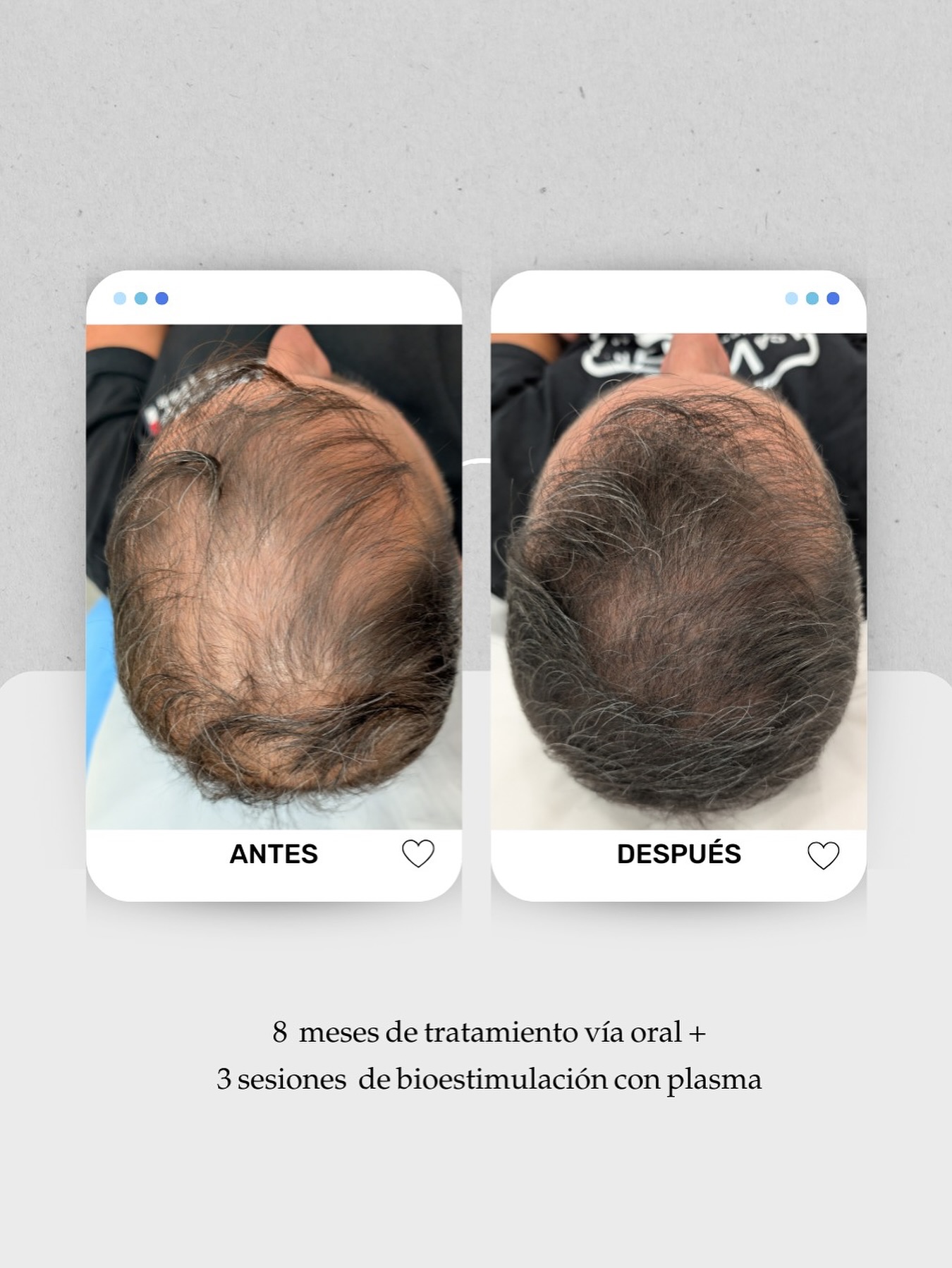 💭 “Ya me hice un trasplante, ¿por qué sigo perdiendo pelo?”
Es una de las preguntas más frecuentes en consulta.
Y la respuesta está en algo que muchas veces se pasa por alto: el mantenimiento.
💆🏻♂️Este paciente llegó después de su trasplante capilar sin haber realizado ningún tratamiento posterior, y con el tiempo había perdido parte del cabello trasplantado y del propio.
Tras una valoración tricológica, adaptamos un plan integral:
✅ 3 sesiones de bioestimulación con plasma (PRP)
✅ Tratamiento oral personalizado para fortalecer el folículo
⚠️Los tratamientos orales, tópicos e inyectables en consulta no solo sirven para potenciar el resultado del trasplante, sino —sobre todo— para mantener el cabello que no ha sido trasplantado, porque ese sigue envejeciendo y necesita cuidados.
Hoy el paciente ha recuperado grosor, vitalidad y densidad capilar.
📍 Consulta capilar en Lanzarote y Las Palmas de Gran Canaria
📞 680 73 14 53 (Lanzarote)
📞 696 38 27 55 (Las Palmas)
💬 ¿Te hiciste un trasplante capilar y notas que el pelo se está debilitando otra vez? Cuéntamelo en comentarios o pide tu valoración para revisar tu mantenimiento capilar.