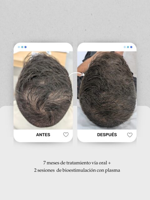 📸 Evolución a los 7 meses de tratamiento capilar en un paciente con pérdida de densidad progresiva y alopecia androgénica.
Tras la valoración tricológica, diseñamos un plan médico adaptado a su diagnóstico. Ahora mismo a constado de:
✅ Tratamiento oral personalizado durante 7 meses.
✅ 2 sesiones de bioestimulación capilar con plasma (PRP).
El resultado: un cuero cabelludo más cubierto, y una coronilla más poblada.
👉 Cada caso de alopecia masculina requiere una estrategia diferente: ajustar la medicación, combinar sesiones en consulta y mantener constancia en el tiempo son claves para recuperar el pelo sin cirugía.
📍 Tratamientos capilares y de alopecia en Lanzarote y Las Palmas de Gran Canaria
📞 680 73 14 53 (Lanzarote)
📞 696 38 27 55 (Las Palmas de Gran Canaria)
💬 ¿Notas tu cabello más fino o con zonas despobladas? Cuéntamelo en comentarios o pide tu valoración médica para estudiar tu caso.