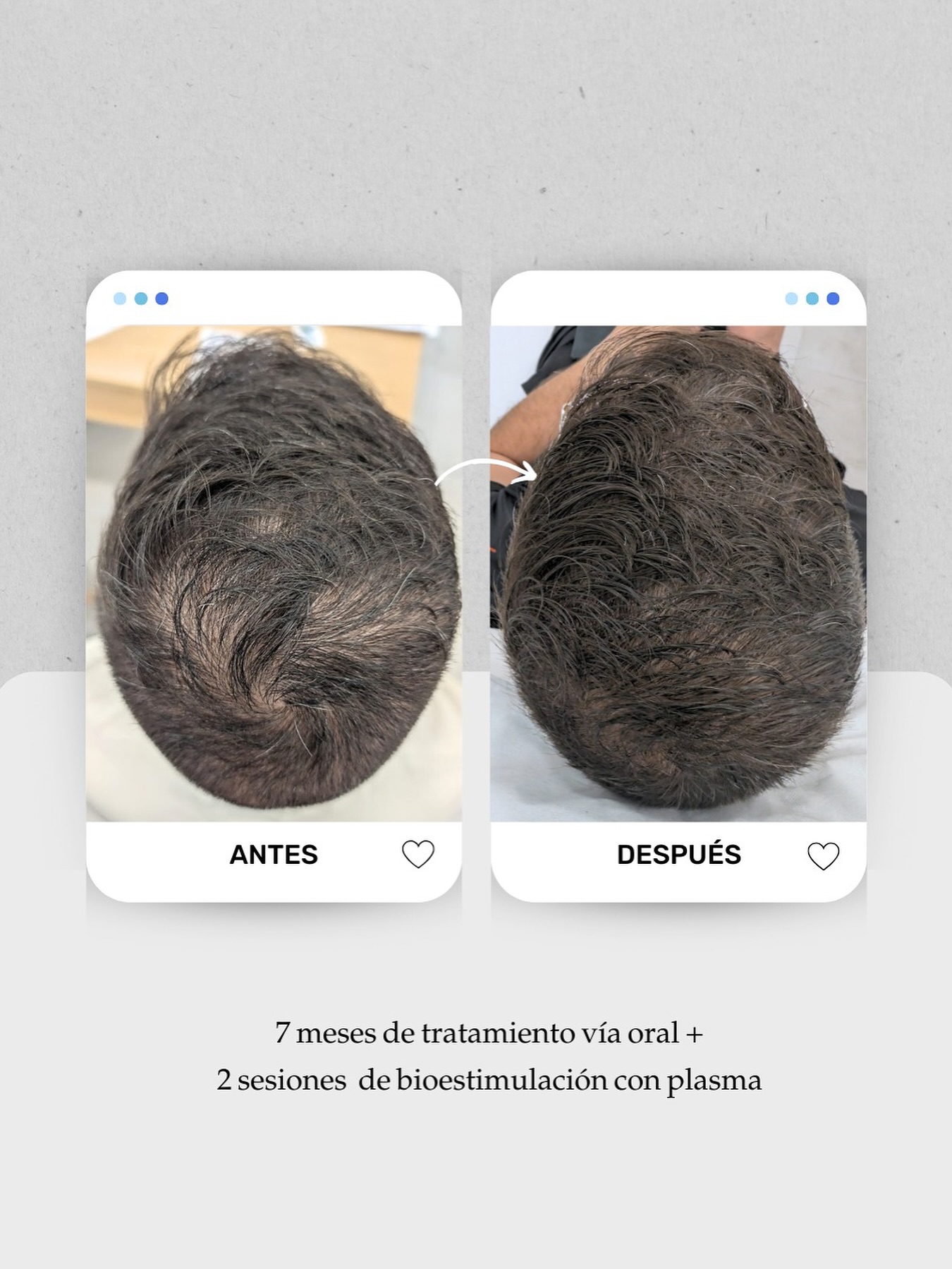 📸 Evolución a los 7 meses de tratamiento capilar en un paciente con pérdida de densidad progresiva y alopecia androgénica.
Tras la valoración tricológica, diseñamos un plan médico adaptado a su diagnóstico. Ahora mismo a constado de:
✅ Tratamiento oral personalizado durante 7 meses.
✅ 2 sesiones de bioestimulación capilar con plasma (PRP).
El resultado: un cuero cabelludo más cubierto, y una coronilla más poblada.
👉 Cada caso de alopecia masculina requiere una estrategia diferente: ajustar la medicación, combinar sesiones en consulta y mantener constancia en el tiempo son claves para recuperar el pelo sin cirugía.
📍 Tratamientos capilares y de alopecia en Lanzarote y Las Palmas de Gran Canaria
📞 680 73 14 53 (Lanzarote)
📞 696 38 27 55 (Las Palmas de Gran Canaria)
💬 ¿Notas tu cabello más fino o con zonas despobladas? Cuéntamelo en comentarios o pide tu valoración médica para estudiar tu caso.