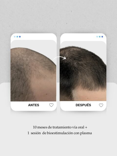 📸 Dependiendo del grado de la alopecia, es posible tratarla sin cirugía. Y cada plan es único… pero casi siempre va por fases.

En este caso, que puedes ver deslizando las imágenes, el objetivo inicial se ha logrado con tratamiento vía oral, que nos permite frenar la caída y empezar a ver respuesta en el cuero cabelludo. Ahora entramos en un plan doble, incorporando bioestimulación con plasma  en consulta para reforzar esas zonas que todavía están menos pobladas y mejorar la calidad del pelo nuevo.

🧠 Tratar una alopecia sin cirugía requiere más paciencia y constancia, sí. Pero bien indicado y bien seguido, ofrece muy buenos resultados a largo plazo y permite que el mantenimiento sea más espaciado en el tiempo.

Seguimos evaluando, ajustando y acompañando el proceso.
📍 Consulta capilar en Lanzarote y Las Palmas de Gran Canaria
 📞 680 73 14 53 | 📞 696 38 27 55
💬 Si te preocupa la caída y quieres saber qué opciones hay en tu caso, escríbeme

#calvicielanzarote #alopecialanzarote #caidadelcabello