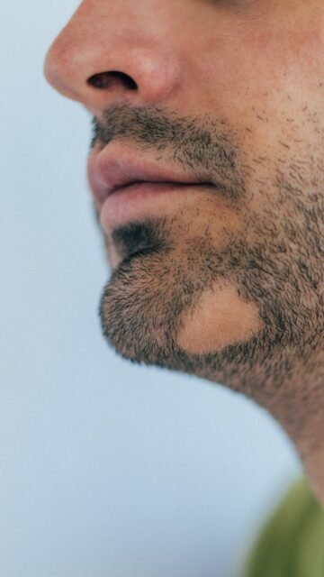 ¿Calvas en la barba o un parche redondo sin pelo? 👀
Puede ser alopecia areata en barba (una reacción autoinmune que “apaga” el folículo de forma temporal). 

Lo que más me preguntáis en consulta: “¿me va a volver a crecer la barba?”

En muchos casos, sí: el folículo no se destruye y con el tratamiento adecuado puede reactivarse. 
Cuanto antes lo valoremos, mejor (para que no se haga más grande). 

📍 📲 Lanzarote: 680 73 14 53 | Las Palmas de Gran Canaria: 696 38 27 55 

¿Te ha pasado o conoces a alguien?  te leo 👇