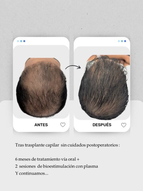 Si te vas a hacer un trasplante capilar, lee esto. 👀
Porque el trasplante no es magia… y no termina el día de la cirugía.

Si no haces postoperatorio y mantenimiento, puedes acabar con un “antes” como este: el pelo trasplantado puede ir bien, pero el pelo no trasplantado sigue su curso (y también envejece).

En este caso: 6 meses de tratamiento vía oral + 2 sesiones de bioestimulación con plasma… y seguimos, porque la recuperación es un proceso. ✅

Mi consejo médico: el postoperatorio (y el plan de seguimiento) puede ser igual o más importante que la propia cirugía.

Y sí: en consulta podemos planificar pre y post tras un trasplante para proteger la zona no implantada y optimizar el resultado.

📍Islas Canarias:
📲 Lanzarote:  680 73 14 53 
📲 Las Palmas de Gran Canaria:  696 38 27 55

#trasplantecapilar #postoperatoriotrasplantecapilar #caidadelpelo #alopecia #saludcapilar