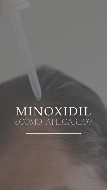 🧴✨ Minoxidil tópico para la alopecia y la caída del cabello: cuándo sí (y cómo usarlo bien).

El minoxidil es uno de los tratamientos más conocidos para estimular el folículo y favorecer el crecimiento capilar 💆‍♀️🌱, pero ⚠️ no está indicado para todos los casos ni para todas las alopecias.

Cuando la vía oral no es la opción elegida, el minoxidil tópico puede ser una alternativa ✅ siempre que esté bien pautado y adaptado a tu diagnóstico 🔍.

En el reel te dejo un tutorial rápido para aplicarlo correctamente 👌

Y para saber qué concentración y qué pauta son las adecuadas para ti, lo ideal es una valoración médica 📋

👩🏻‍⚕️ Dra. Vanessa Márquez
📍 Consulta capilar en Lanzarote y Las Palmas de Gran Canaria
📞 680 73 14 53 | 📞 696 38 27 55

💬 ¿Lo has usado alguna vez? ¿Qué te cuesta más: la constancia ⏳ o cómo te deja el pelo? Te leo 👇