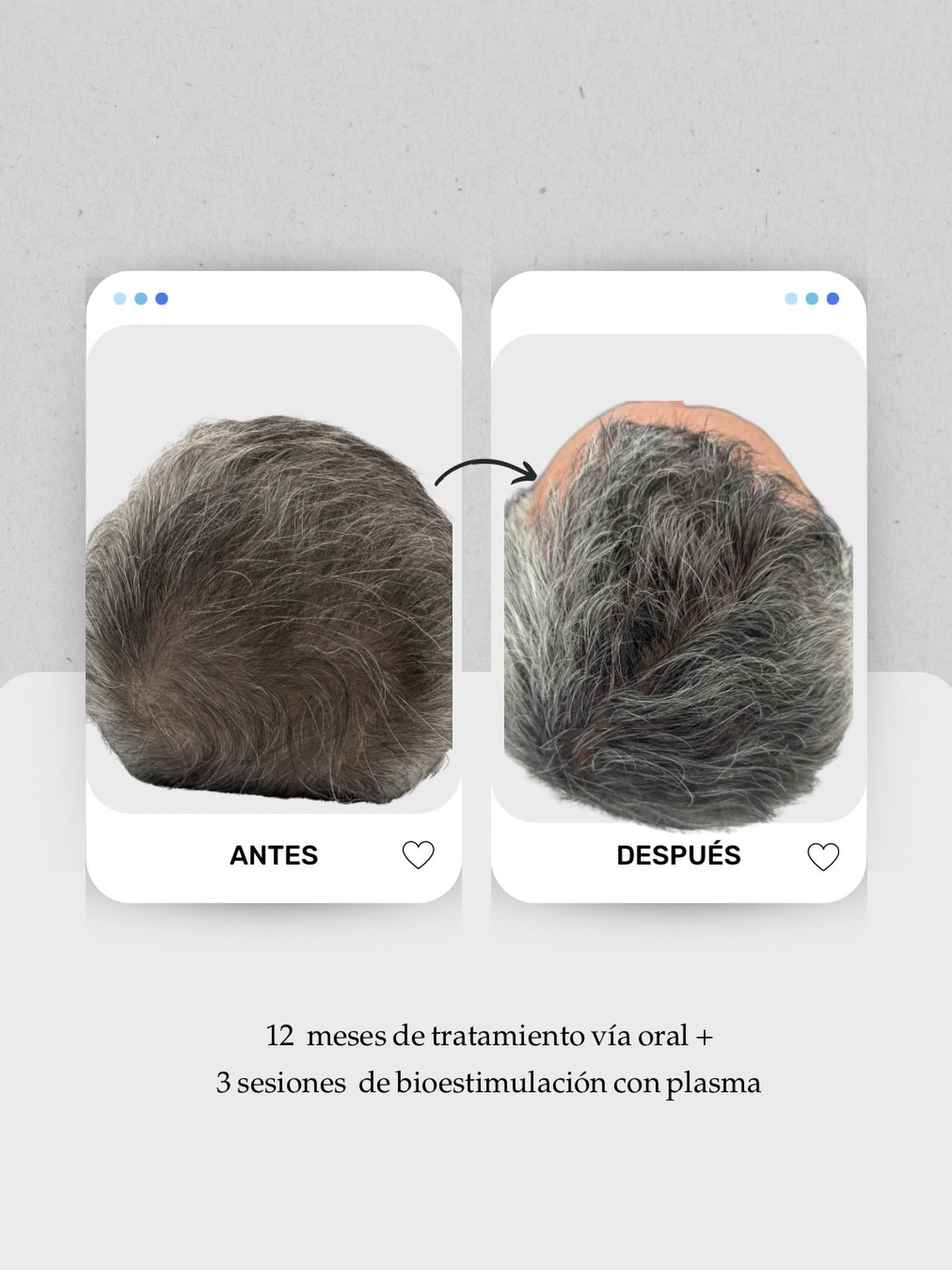 👀 No hace falta llegar a una pérdida evidente para cuidar de tu pelo.

Cuando la densidad ya comienza a cambiar, puede ser una de las primeras señales de alopecia.

En este caso, trabajamos tanto la coronilla como las entradas frontales. Y tras 12 meses de seguimiento, se aprecia una mejoría en densidad y cobertura en las zonas más claras y despobladas.

El plan incluyó:
✔️ Tratamiento vía oral durante 12  meses
✔️ 2 sesiones de bioestimulación en consulta
🧠 En la alopecia masculina, la constancia y el mantenimiento son clave.

No siempre es necesario recurrir a cirugía o trasplante capilar si actuamos en fases iniciales y con un plan médico bien indicado.

‼️Y algo importante: incluso si en el futuro se plantea un trasplante, el tratamiento médico seguiría siendo imprescindible para mantener el resto del cabello.

👩🏻‍⚕️ Dra. Vanessa Márquez- Médico capilar
📍 Consulta en Lanzarote y Las Palmas de Gran Canaria
📞 680 73 14 53 | 📞 696 38 27 55