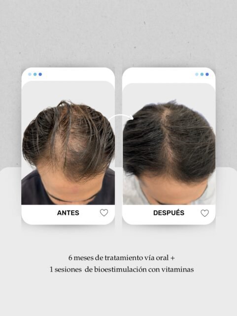 👀 Desliza y fíjate bien en la evolución.
Cuando tratamos una alopecia a tiempo, el objetivo no es solo frenar la caída, sino recuperar densidad y calidad del cabello de forma progresiva.
En este caso trabajamos durante 6 meses combinando:
✔️ Tratamiento médico vía oral.
✔️ 1 sesión de bioestimulación capilar con vitaminas en consulta.
El resultado empieza a notarse sobre todo en las zonas donde el cabello estaba más afinado o despoblado. Y a partir de aquí, lo importante es mantener y seguir estimulando el folículo.
Cada alopecia es diferente, por eso siempre realizamos una valoración capilar completa antes de pautar el tratamiento más adecuado.
👩🏻⚕️ Dra. Vanessa Márquez
Medicina capilar
📍 Consulta en Lanzarote y Las Palmas de Gran Canaria
📞 680 73 14 53 | 📞 696 38 27 55
💬 Si notas que tu pelo está perdiendo densidad, cuanto antes se valore… mejores suelen ser los resultados