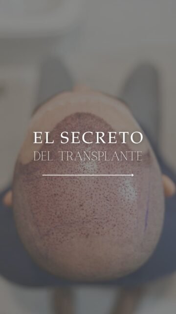 ⚠️ 💬 ¿Estás valorando un trasplante o ya te lo has hecho? ¿Te hablaron del mantenimiento del pelo nativo?
Por eso, el plan no termina el día de la cirugía.

Normalmente recomendamos mantenimiento para cuidar ese pelo que sigue siendo sensible a la alopecia:
• tratamiento oral cuando está indicado 💊
• suplementación específica 🧬
• sesiones de bioestimulación en consulta (PRP, vitaminas, fármacos, terapias regenerativas) 💉

El objetivo es mantener la densidad y que el resultado se vea natural con el paso del tiempo.

👩🏻‍⚕️ Dra. Vanessa Márquez
Especialista en alopecia y medicina capilar
📍 Consulta en Lanzarote y Las Palmas de Gran Canaria
📞 680 73 14 53 | 696 38 27 55

#trasplantecapilar #trasplantecapilarcanarias #saludcapilarlanzarote