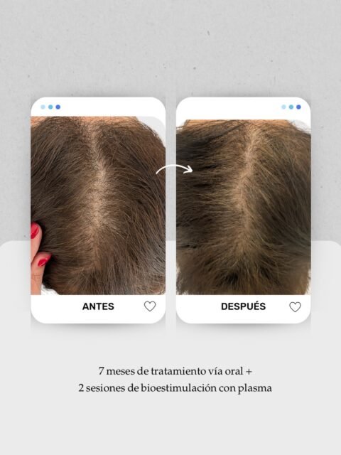 ✨ Caso en evolución: mejora de densidad en la raya media.
Cuando el pelo se afina (miniaturización capilar), la raya se ve más ancha y el cuero cabelludo se hace más visible. Con un diagnóstico adecuado y un plan personalizado, podemos mejorar la calidad del folículo y recuperar cobertura progresivamente.
Tratamiento:
7 meses de tratamiento vía oral + 2 sesiones de bioestimulación con plasma 🧬
👩🏻⚕️ Dra. Vanessa Márquez
Especialista en alopecia femenina y masculina · caída del cabello · medicina capilar
📍 Consulta en Lanzarote y Las Palmas de Gran Canaria
📞 680 73 14 53 | 696 38 27 55
💬 ¿Has notado que tu raya se ha ido ensanchando con el tiempo