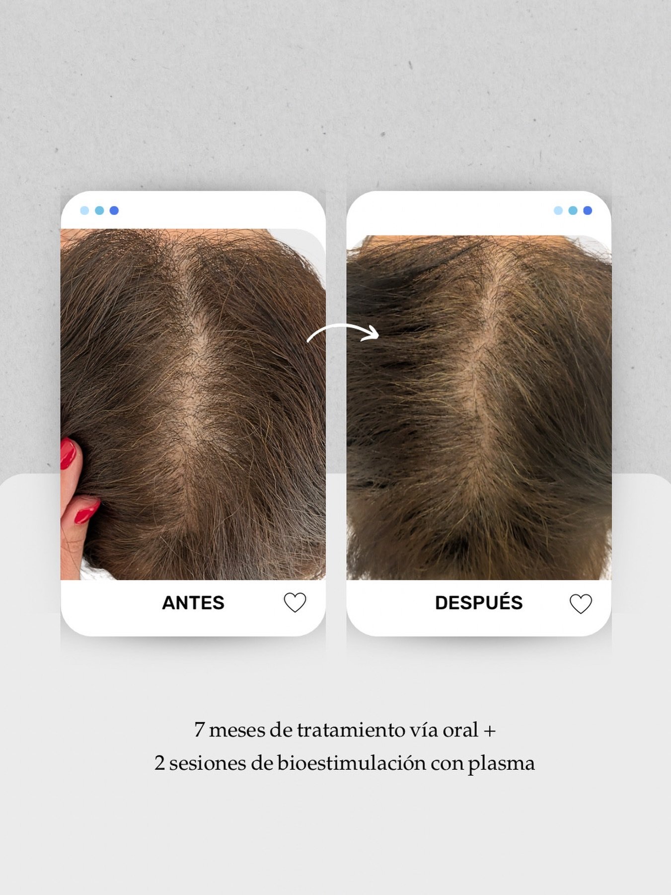 ✨ Caso en evolución: mejora de densidad en la raya media.
Cuando el pelo se afina (miniaturización capilar), la raya se ve más ancha y el cuero cabelludo se hace más visible. Con un diagnóstico adecuado y un plan personalizado, podemos mejorar la calidad del folículo y recuperar cobertura progresivamente.
Tratamiento:
7 meses de tratamiento vía oral + 2 sesiones de bioestimulación con plasma 🧬
👩🏻⚕️ Dra. Vanessa Márquez
Especialista en alopecia femenina y masculina · caída del cabello · medicina capilar
📍 Consulta en Lanzarote y Las Palmas de Gran Canaria
📞 680 73 14 53 | 696 38 27 55
💬 ¿Has notado que tu raya se ha ido ensanchando con el tiempo
