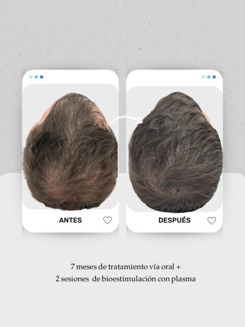 📊 Más del 50% de los hombres notan pérdida de densidad capilar antes de los 50 años.

En este caso trabajamos entradas y coronilla, dos zonas donde suele apreciarse una disminución de cobertura del cabello.

Tratamiento:
7 meses de tratamiento vía oral + 2 sesiones de bioestimulación con plasma 🧬

Cada alopecia es diferente, por eso el diagnóstico y el plan son siempre personalizados, según la causa y la fase del folículo.

👩🏻‍⚕️ Dra. Vanessa Márquez
Especialista en alopecia masculina · caída del cabello · medicina capilar

📍 Lanzarote y Las Palmas de Gran Canaria
📞 680 73 14 53 | 696 38 27 55