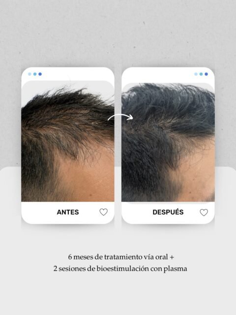 📈 Caso en evolución: entradas, coronilla y pérdida de densidad general.

En muchos casos de alopecia androgenética, el pelo no se cae de golpe: se va afinando poco a poco hasta que el cuero cabelludo empieza a verse más 👀

El tratamiento hasta ahora ha sido:
 🧠 6 meses de tratamiento vía oral
 🧬 2 sesiones de bioestimulación con plasma

El objetivo no es solo recuperar densidad, sino también mejorar la calidad del folículo y acompañar el mantenimiento del cabello a largo plazo ✨

Si crees que esto le puede estar pasando a alguien, compártele este caso 📲

 Y si te pasa algo similar, te espero en consulta.

👩🏻‍⚕️ Dra. Vanessa Márquez
 Medicina capilar · Alopecia · Caída del cabello
📍 Consulta capilar en Canarias
 Lanzarote: 680 73 14 53
 Las Palmas de Gran Canaria: 696 38 27 55

#alopecialanzarote #calviciemasculina #sininjertocapilar #