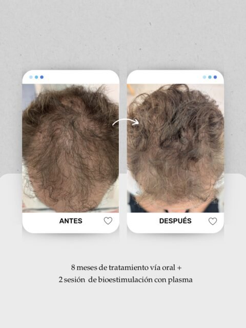 📈 Caso en evolución: alopecia androgenética avanzada.
Cuando la pérdida de densidad lleva tiempo evolucionando, el objetivo muchas veces no es solo “que salga pelo”, sino recuperar calidad, grosor y mejorar la cobertura del cuero cabelludo 👀
El tratamiento hasta ahora:
🧠 8 meses de tratamiento vía oral
🧬 2 sesiones de bioestimulación con plasma
Y sí: aunque cada caso y cada alopecia son distintos, muchas veces todavía podemos mejorar muchísimo sin cirugía si actuamos a tiempo ✨
👩🏻⚕️ Dra. Vanessa Márquez
Medicina capilar · Alopecia · Caída del cabello
📍 Lanzarote: 680 73 14 53
📍 Las Palmas de Gran Canaria: 696 38 27 55
💬 Si conoces a alguien que lleve años normalizando su caída capilar, envíale este caso.