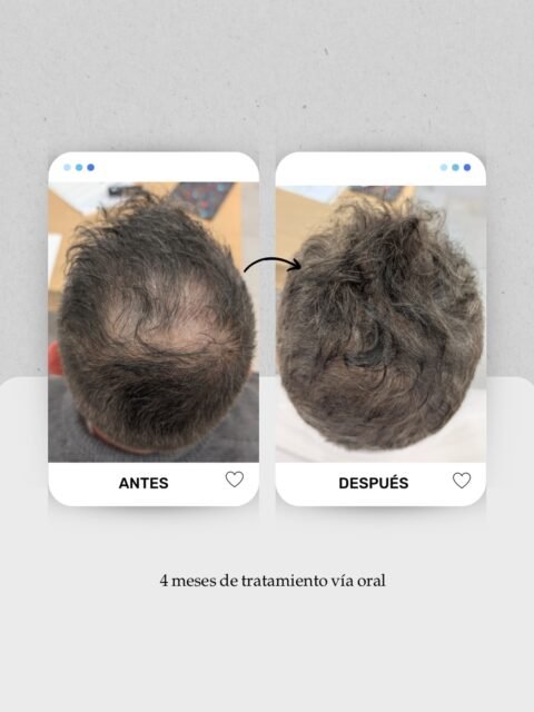 📈 4 meses de tratamiento médico capilar… y este cambio ya empieza a notarse 👀

En este caso trabajamos una alopecia androgenética masculina con pérdida de densidad sobre todo en coronilla y zona superior del cuero cabelludo.

El tratamiento hasta ahora ha sido únicamente:
 🧠 Tratamiento vía oral durante 4 meses.

Y aunque cada alopecia y cada paciente son distintos, cuando actuamos a tiempo muchas veces podemos mejorar densidad, grosor y calidad del cabello sin cirugía ✨

En medicina capilar, lo importante no es solo “que se caiga menos pelo”, sino entender qué está pasando en el folículo y acompañar el caso con seguimiento y mantenimiento 🧬

👩🏻‍⚕️ Dra. Vanessa Márquez
 Tricología · Alopecia · Caída del cabello · Medicina capilar
 📍 Lanzarote: 680 73 14 53
 📍 Las Palmas de Gran Canaria: 696 38 27 55