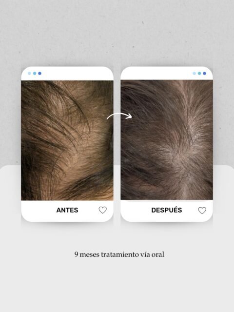 📈 Cuando la raya empieza a ensancharse, muchas veces el pelo lleva tiempo perdiendo grosor sin que nos demos cuenta.
En este caso, tras 9 meses de tratamiento médico vía oral, vemos una mejoría progresiva de la densidad y una menor visibilidad del cuero cabelludo en la zona central.
El objetivo no es solo frenar la caída, sino mejorar el grosor del cabello y conservar el folículo activo durante el mayor tiempo posible 🧬
Cada alopecia evoluciona de forma distinta, por eso el diagnóstico y el seguimiento son fundamentales para ajustar el tratamiento a cada paciente.
👩🏻⚕️ Dra. Vanessa Márquez
Medicina capilar · Alopecia femenina · Pérdida de densidad
📍 Lanzarote: 680 73 14 53
📍 Las Palmas de Gran Canaria: 696 38 27 55
📲 Si conoces a alguien que ha notado la raya más ancha, compártele este caso.
#AlopeciaFemenina #MedicinaCapilar #PerdidaDeDensidad #CaidaDelCabello Tricologia