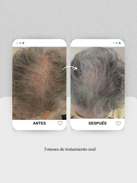🗓️Tres meses. Eso es todo lo que separa estas dos imágenes.

Y no, no es cuestión de suerte.
En este caso, tras 3 meses de tratamiento oral, ya podemos apreciar una mejora en la densidad y una menor visibilidad del cuero cabelludo.

Cada paciente necesita un estudio previo para identificar la causa de su caída. Solo así podemos diseñar un tratamiento personalizado y decidir si el tratamiento oral es suficiente o si conviene combinarlo con procedimientos en consulta para potenciar los resultados.

💚 Gracias a mi paciente por confiar en mí y permitirme compartir su evolución.

👩🏻‍⚕️ Como especialista en medicina capilar, mi objetivo es tratar la causa de la caída para conseguir resultados naturales, progresivos y duraderos.

📍 Lanzarote: 680 73 14 53
 📍 Las Palmas de Gran Canaria: 696 38 27 55
📲 Reserva tu valoración desde el enlace de la bio o por WhatsApp.

#MedicinaCapilar #Alopecia #PRPcapilar #SaludCapilar Tricología
