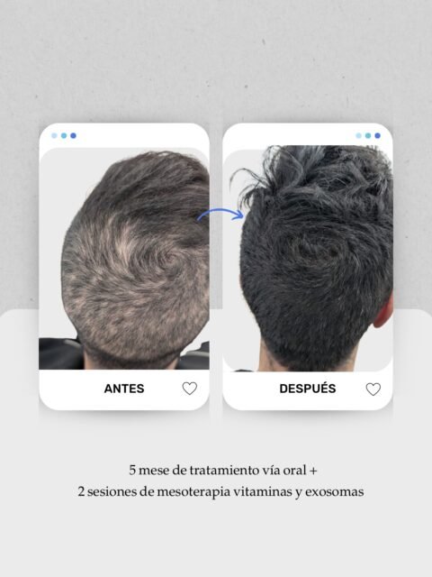 5 meses separan estas imágenes. Pero este resultado no lo consiguió una sola cosa. 👉 Desliza para ver la evolución.
👨🏻 Mi paciente ya presentaba una alopecia androgenética cuando atravesó un periodo de estrés muy intenso que desencadenó una caída brusca y muy llamativa relacionada con un efluvio telógeno.
¿El enfoque? Tratamiento oral durante estos meses, sesiones de mesoterapia con vitaminas y exosomas en consulta, suplementación indicada según su analítica y, algo igual de importante: mejorar hábitos, descanso y manejo del estrés.
👩🏻⚕️ En medicina no siempre existe un tratamiento que lo resuelva todo. Primero necesitamos un buen diagnóstico y, a partir de ahí, sumar las herramientas que necesita cada caso.
Y aquí tengo que darle las gracias a mi paciente 🤍 porque se dejó guiar, hizo su parte y trabajamos juntos para conseguir esta evolución.
A veces, dormir mejor o aprender a gestionar el estrés incluso pidiendo ayuda de profesiones, también forma parte de cuidar nuestra salud capilar.
📲 Citas y valoración capilar por WhatsApp.
📍 Lanzarote: 680 73 14 53
📍 Las Palmas de Gran Canaria: 696 38 27 55
#AlopeciaAndrogenetica #EfluvioTelogeno #MedicinaCapilar #CaidaDelCabello #Tricologia