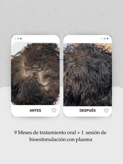 9 meses de tratamiento y una evolución que va por muy buen camino. ⏳✨

👩🏻‍⚕️ Mi paciente acudió a consulta con alopecia androgénica Grado I-II. A partir de ahí pautamos tratamiento oral y lo complementamos con una sesión de bioestimulación con su propio plasma.

👉 Desliza para ver cómo hemos conseguido mayor densidad, mejor cobertura y menor exposición del cuero cabelludo.

🤍 En medicina estetica capilar los resultados son progresivos: necesitamos tiempo, constancia y seguimiento para valorar la respuesta y ajustar el tratamiento cuando sea necesario.

Gracias a mi paciente por confiar en el proceso y permitirme compartir su evolución. 🙌

📍 Lanzarote: 680 73 14 53
 📍 Las Palmas de Gran Canaria: 696 38 27 55

#Alopecia #MedicinaCapilar #TratamientoCapilar #PRPcapilar #SaludCapilar