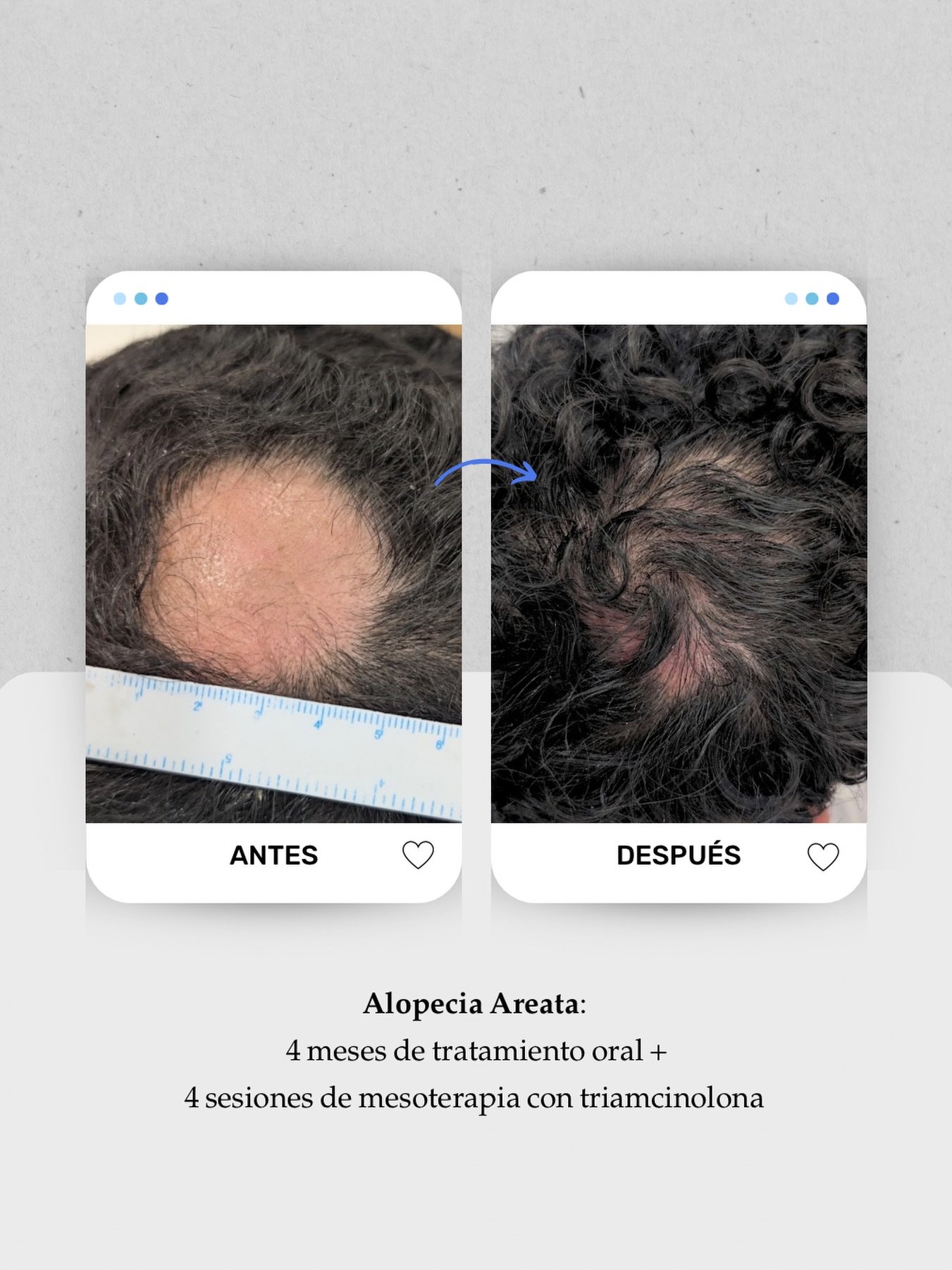 ¿Te ha aparecido de repente una “calva” redonda en el pelo? 👀 Puede tratarse de una placa de alopecia areata.
👩🏻⚕️ Esta paciente llegó a consulta con una placa de aproximadamente 4 cm. Tras la valoración, diagnosticamos alopecia areata, un tipo de alopecia de origen autoinmune que provoca una pérdida localizada del cabello y que no destruye el folículo como ocurre en las alopecias cicatriciales. 🌱
En su historia clínica también presentaba dermatitis seborreica, por lo que era importante valorar el cuero cabelludo en conjunto y no quedarnos únicamente con lo que veíamos a simple vista. 🔎
💊 Durante 4 meses combinamos tratamiento médico oral con 4 sesiones de mesoterapia con triamcinolona para controlar el proceso inflamatorio y favorecer la recuperación del crecimiento.
✨ En la imagen ya podemos observar una importante repoblación de la zona, pero el tratamiento continúa con el objetivo de conseguir una repoblación completa.
Cada alopecia necesita un diagnóstico y un abordaje diferente. Si notas una placa o “calva” que ha aparecido de forma repentina, lo primero es saber qué está ocurriendo.
📍 Lanzarote: 680 73 14 53
📍 Las Palmas de Gran Canaria: 696 38 27 55
#AlopeciaAreata #TratamientoAlopecia #MedicinaCapilar #CaidaDelCabello #Tricologia
