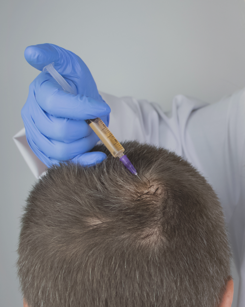 mesoterapia capilar